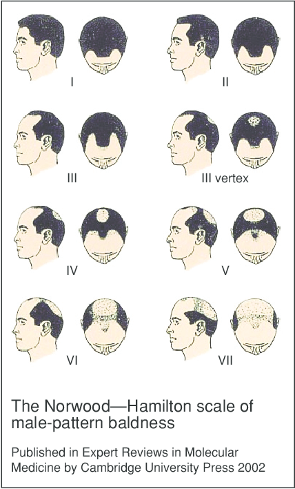 Male Pattern Baldness Stages